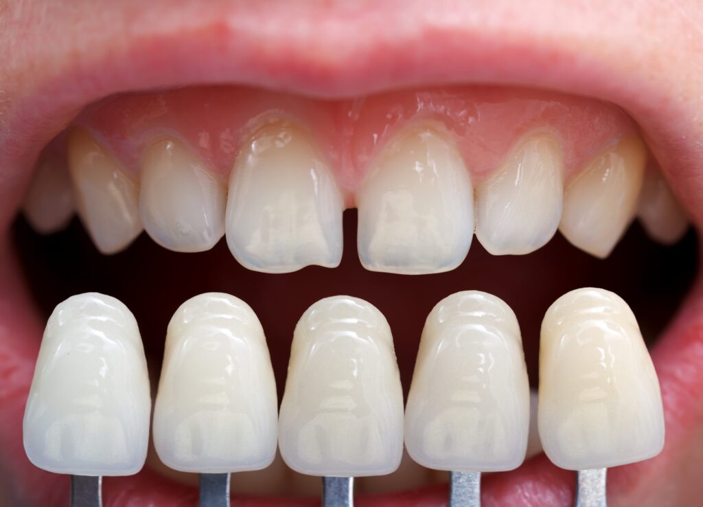 Everything You Need To Know About Dental Veneers 1